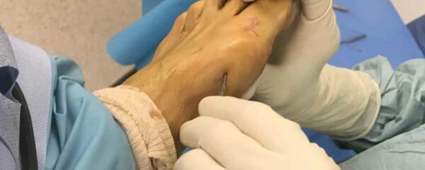 chirurgie mini-invasive du pied