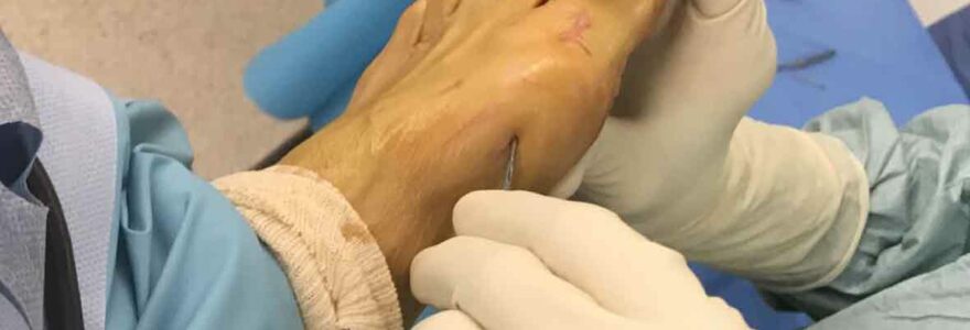 chirurgie mini-invasive du pied